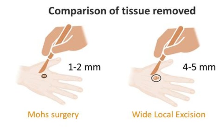 Are excision and incision the same?