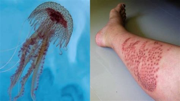 Are thimble jellyfish dangerous?