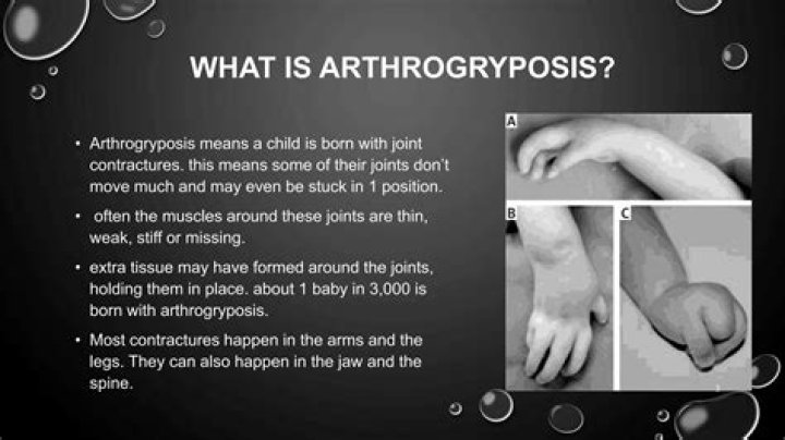 Can arthrogryposis be prevented?