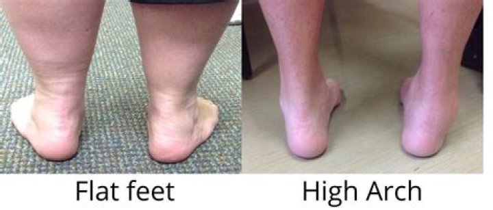 Can flat footed be drafted?