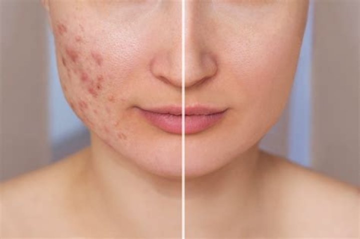 Does the sun clear up acne?
