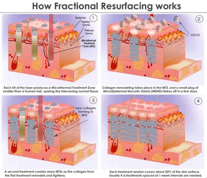 How erbium laser works?