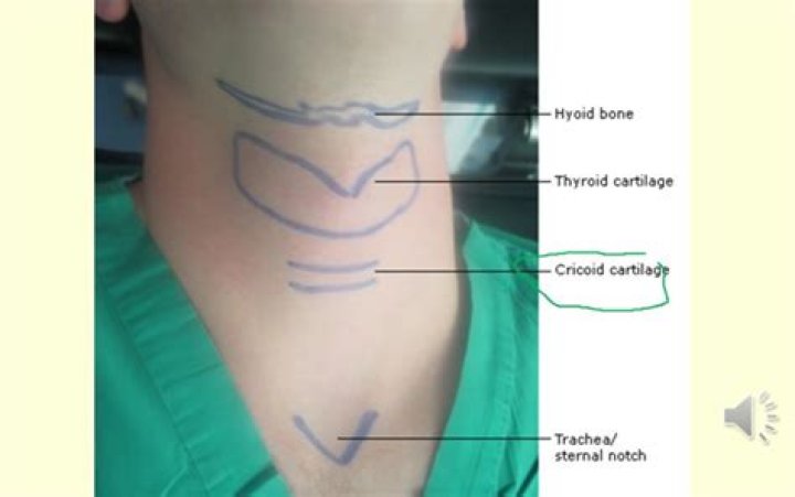 How to cricoid pressure?