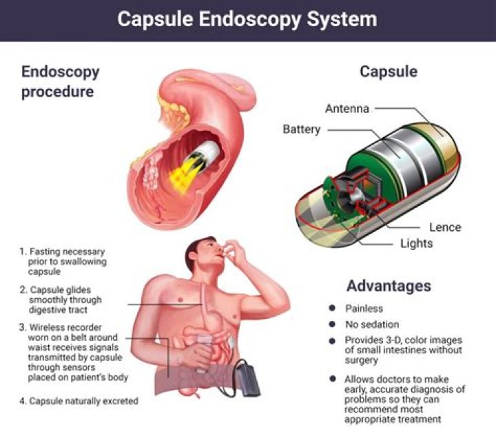 How uncomfortable is an endoscopy?