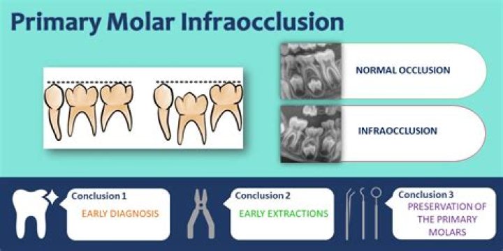 Infraocclusion definition in orthodontics?