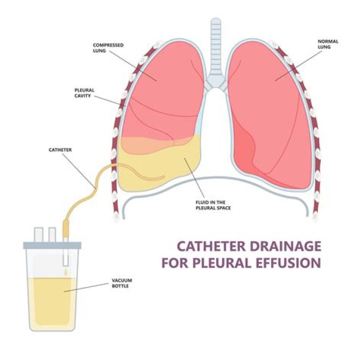 Intrapleural in medical definition?