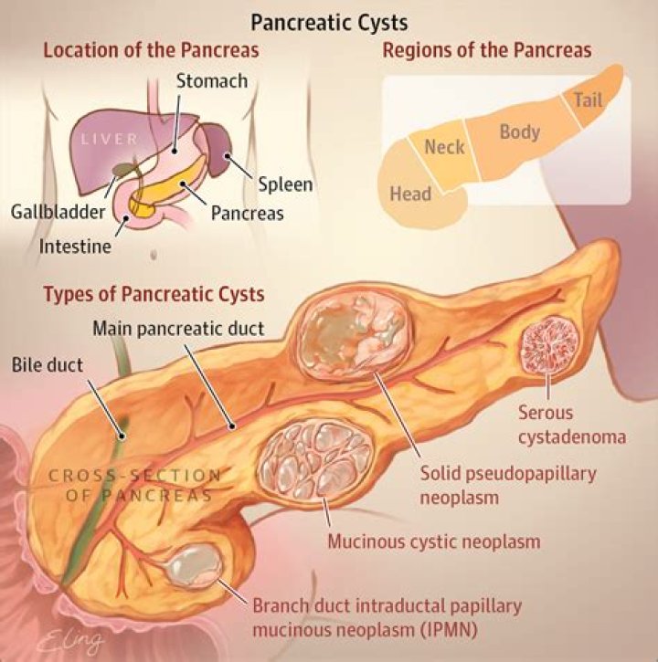 Should pancreatic cysts be removed?