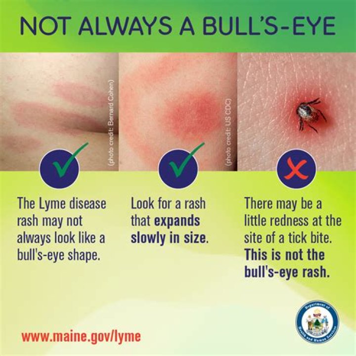 Should you go to the er for a bullseye rash?