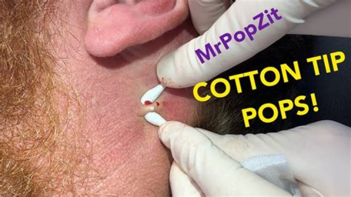 Should you pop cysts?