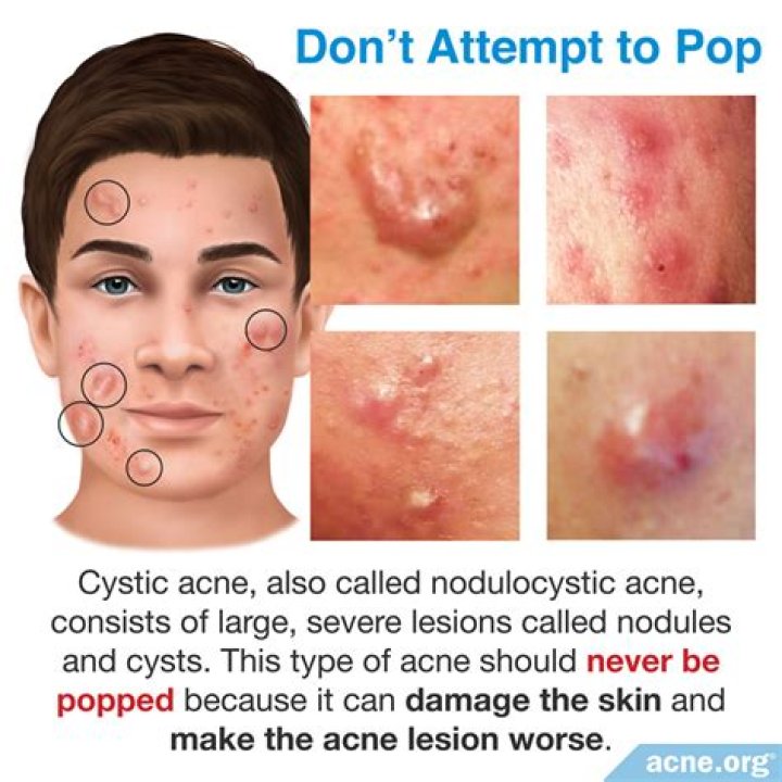 Should you pop epidermoid cyst?