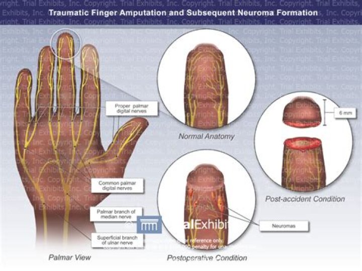 What does an interdigital cyst look like?