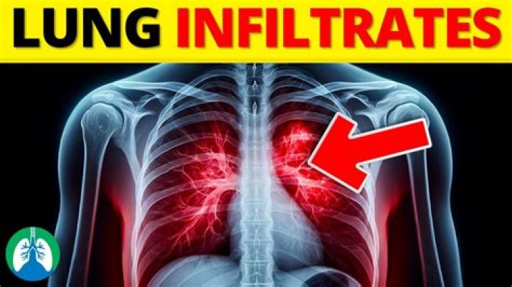 What is pneumonic infiltrate?