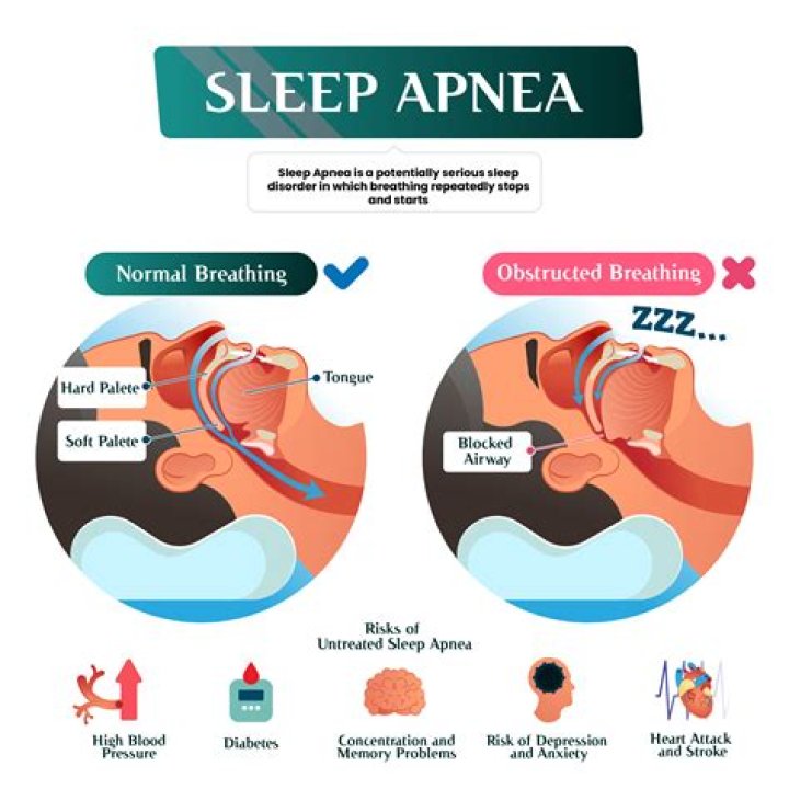 Whats central sleep apnea?