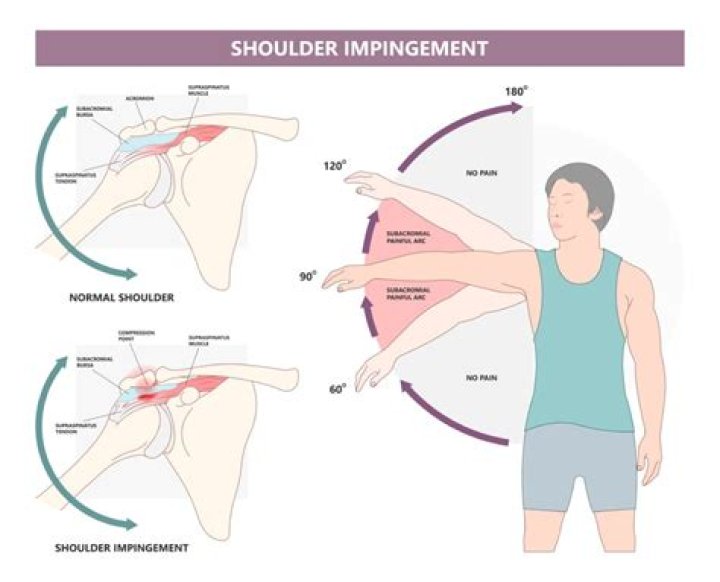 When does shoulder impingement go away?