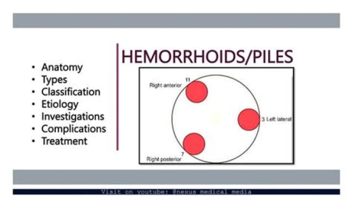 Where are haemorrhoids located?