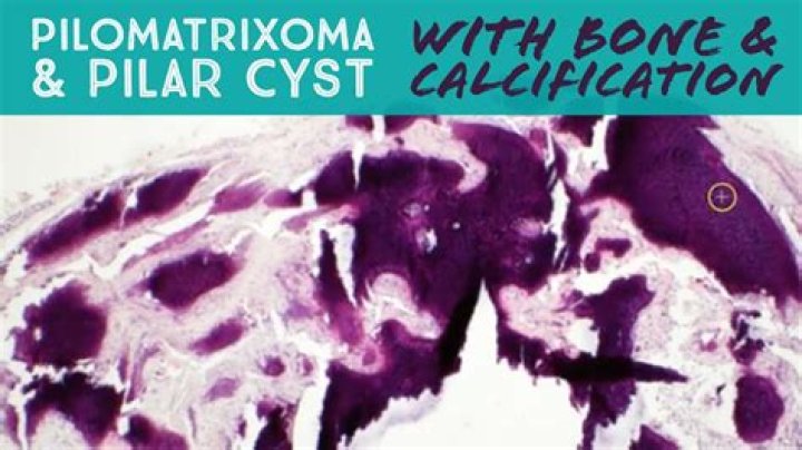 Where is the metaplastic bone?