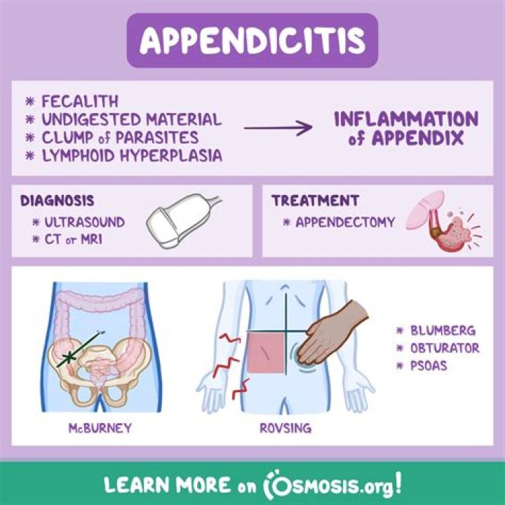 Why migratory pain in appendicitis?