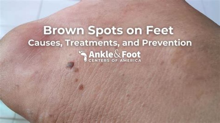 Why outbreak of spots?