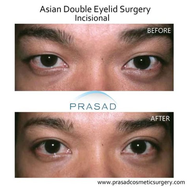Will diplopia go away?
