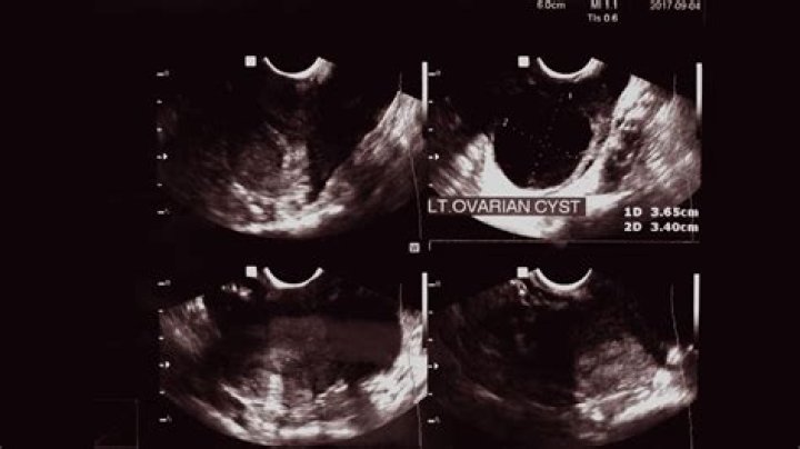 Would i know if i had ovarian cysts?