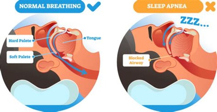 Would losing weight help sleep apnea?